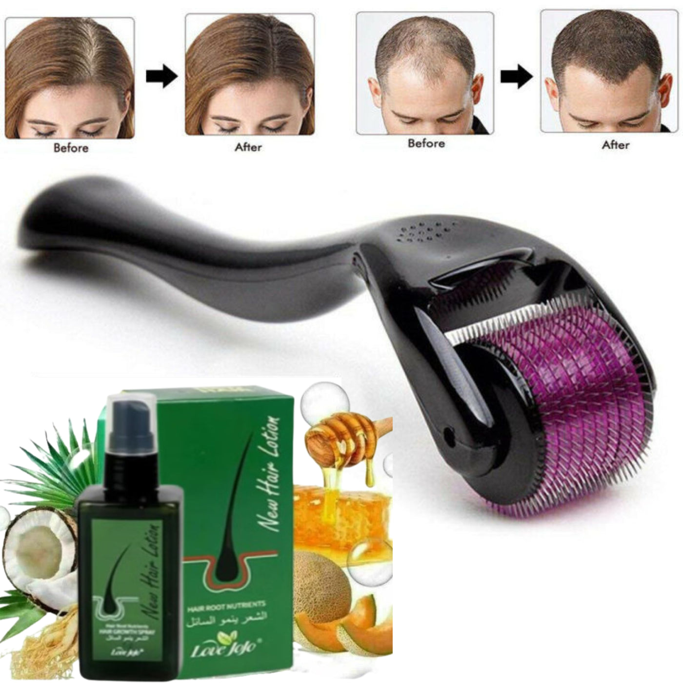 Hair Growth & New Hair Lotion + Derma Roller – Combo Deal